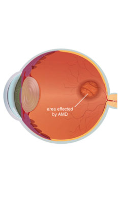 Macular degeneration