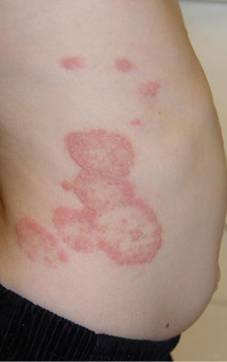 picture of skin fungal infection