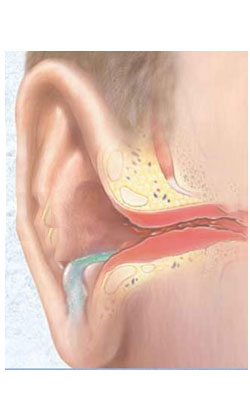 Otitis externa