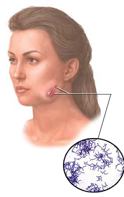 Actinomycosis