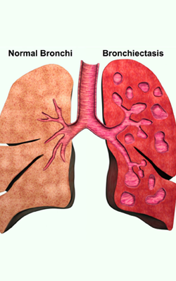 Bronchiectasis introduction,symptoms