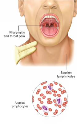 Glandular Fever