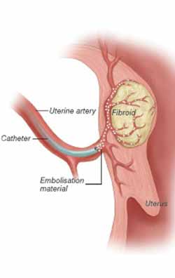 menorrhagia 