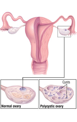 polycystic-ovarian-syndrome 