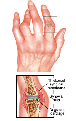 rheumatoid-arthritis