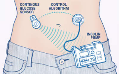 artificial pancreas