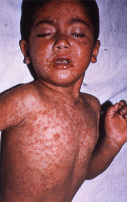 German Measles