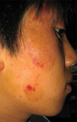 mobile-phone-usage-in-allergic-reactions
