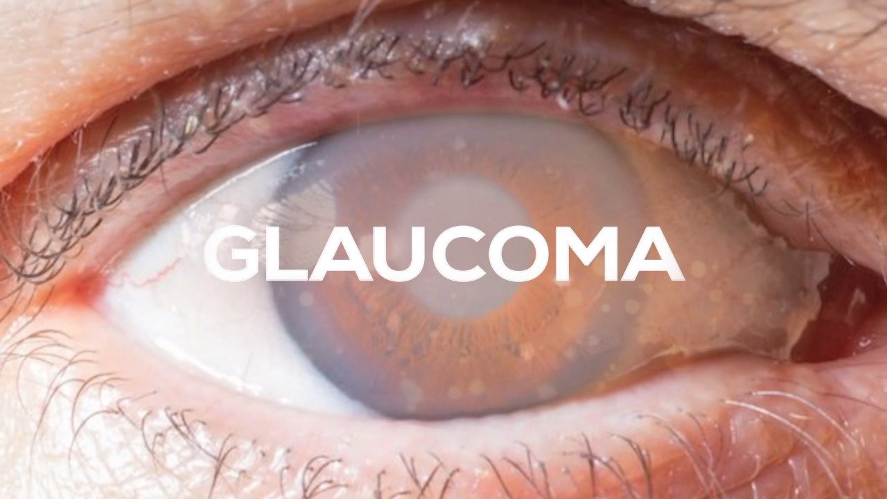 Glaucoma