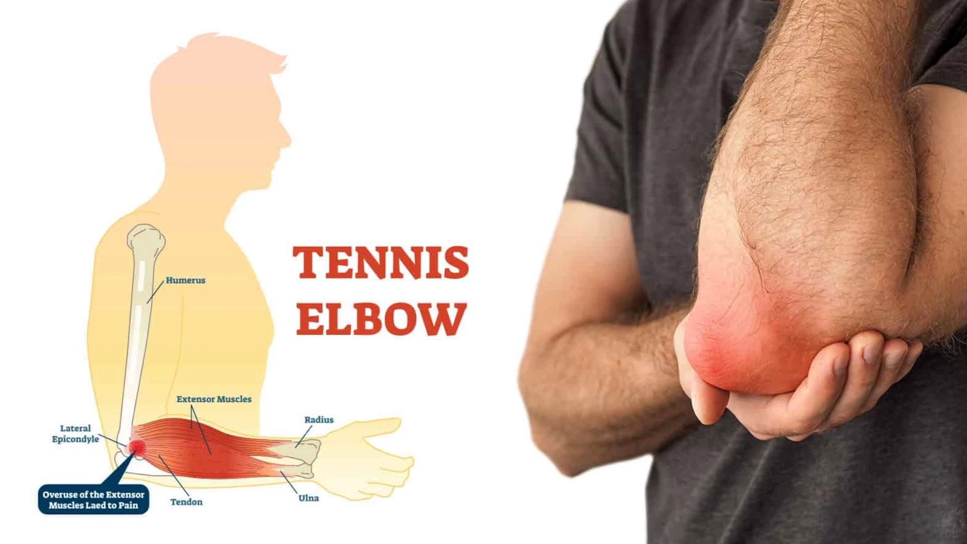 Tennis Elbow